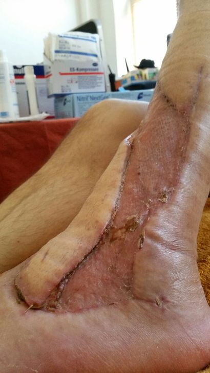 Wunde am Unterschenkel.